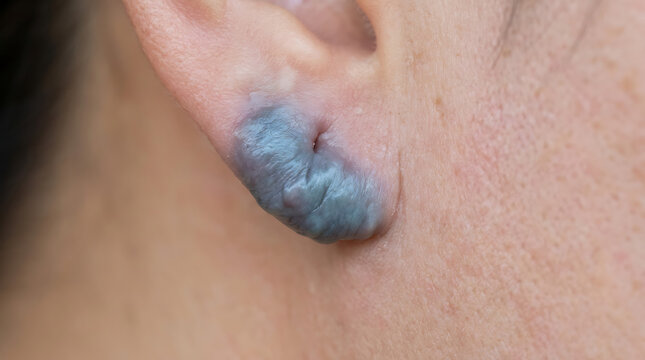 Close-up of a dark blue nevus or mole on a human earlobe, medical skin condition detail