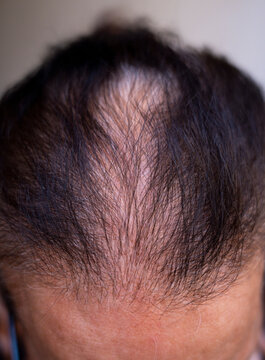 Top view of human head showing progressive hair loss and thinning scalp area with middle aged alopecia thinning dermatology receding follicle wellness clinical treatment medicine condition