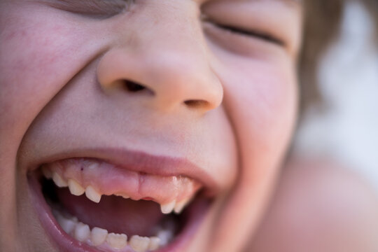 Close-up of a happy kid giggling with open mouth, focusing on his dental growth and missing upper primary teeth.
