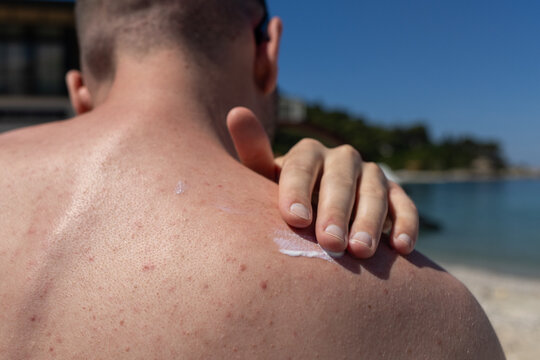 man sunbathing on a beach with sunscreen lotion applied on his back. Focus on skin protection, UV safety, summer tanning, and sun care during outdoor отдых at the seaside