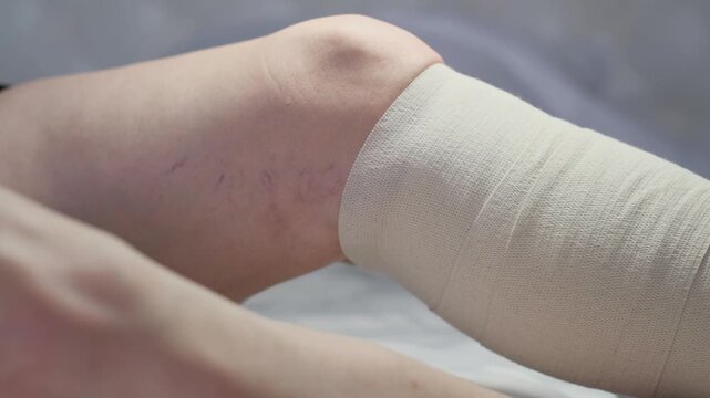 Close-up of an elastic bandage on a woman's leg with varicose veins