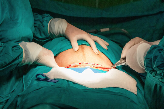 Cesarean section incision during childbirth surgery in hospital operating room. Close-up of surgical team performing obstetric procedure under sterile conditions.