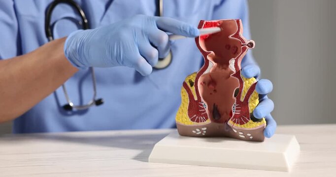 Doctor showing model of unhealthy lower rectum with inflamed vascular structures at light wooden table in clinic, closeup