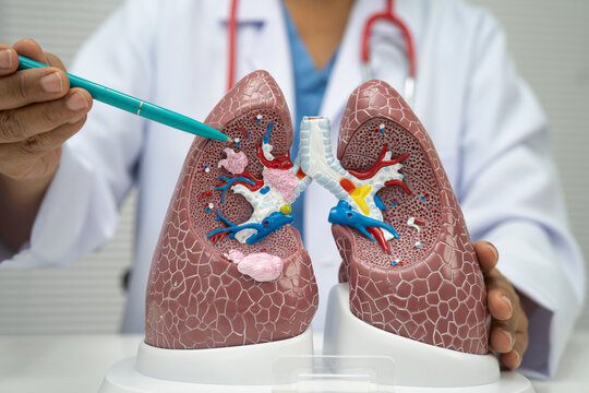 Pneumonia, lung cancer, Asian doctor with human lung model.