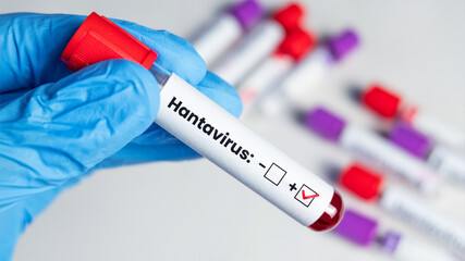 Fototapeta premium Gloved hand holding a blood sample tube indicating a positive Hantavirus result. Medical diagnosis, infectious disease detection, outbreak monitoring, laboratory analysis, and healthcare concept.