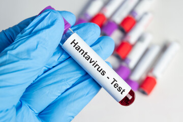 Obraz premium Close-up view of a blood sample tube labeled Hantavirus Test in a laboratory setting.