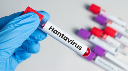 Obraz premium Laboratory technician holding a blood test tube labeled Hantavirus with medical samples in the background.