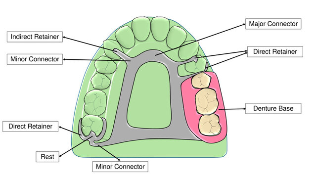 Removable Partial Denture Framework Design Maxillary Dental Arch - Labelled