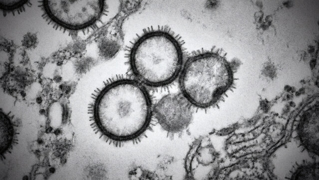 Microscopic view of SARS-CoV-2 coronavirus particles under electron microscope