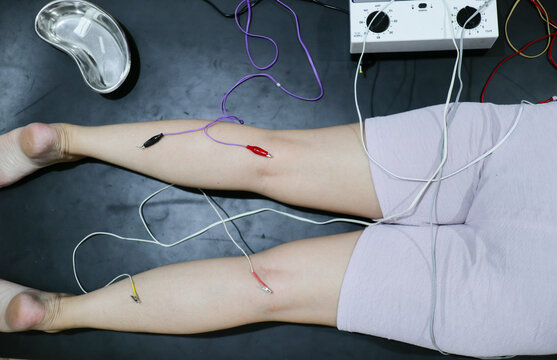Electroacupuncture therapy on a woman, needles stimulated by a machine for relaxation and wellness.