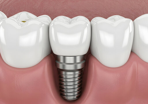 Close up of a single dental implant crown replacement procedure in human gums showing metal post and white tooth