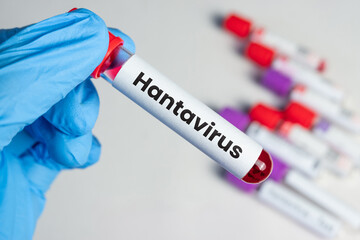 Obraz premium Hantavirus Blood Sample Tube in Laboratory Setting