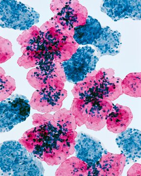 Medium shot of ovarian cancer cells under high magnification highlighting irregular blue nuclei and clustered malignant morphology with pink cytoplasm on a crisp white microscope