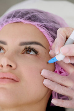 Cosmetic facial marking before aesthetic procedure