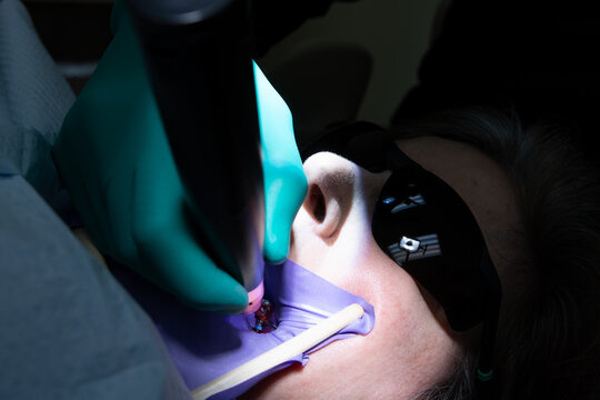 Patient receiving root canal therapy during endodontic procedure in dental clinic. with the hands, dental instruments, mirror, rubber dam isolation, and tweezers.