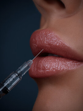 Close-Up Lip Filler Injection Procedure On Natural Full Lips For Cosmetic Beauty And Aesthetics