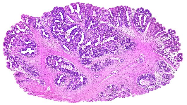 histopathology of human gallbladder adenocarcinoma stained with hematoxylin and eosin (H&E), invasive irregular malignant glands, desmoplastic stromal reaction, and glandular crowding.