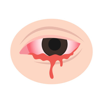 A close-up view of a human eye with bloodshot and bleeding