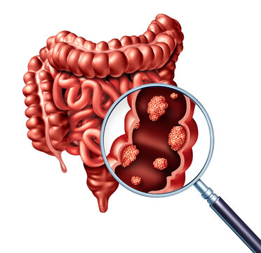 colorectal cancer; colon cancer; colorectal cancer screening; colonoscopy; colorectal screening; cancer screening; colon; large intestine; intestine; colon anatomy; colorectal; bowel; digestive health