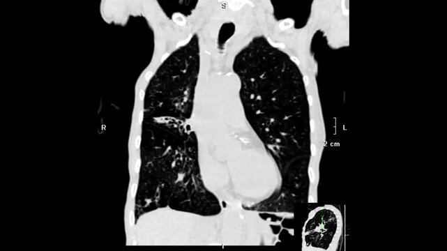 chest CT image demonstrating detailed lung parenchyma, airways, and mediastinal structures. Derived from real CT imaging data for clinical assessment, not AI-generated
