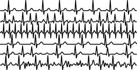 Obraz premium Collection of electrocardiogram ECG heartbeat waveforms showing normal and abnormal cardiac rhythm monitoring patterns