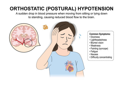 Orthostatic (Postural) Hypotension Medical Flashcard