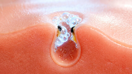 Fototapeta premium Realistic dermatology artwork featuring a blocked pore releasing impurities.
