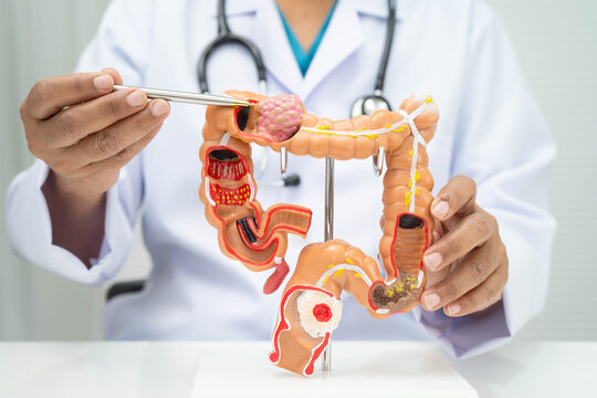 Colorectal cancer, doctor holding intestine colon human anatomy model.