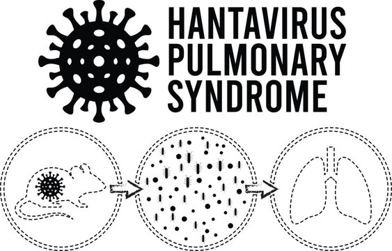 Hantavirus Pulmonary Syndrome Illustration: A graphic illustration depicting the transmission cycle of Hantavirus Pulmonary Syndrome, showing a rodent, airborne particles, and human lungs.