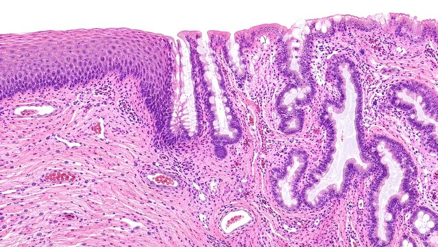 Human uterine cervix showing the squamocolumnar junction and transformation zone.