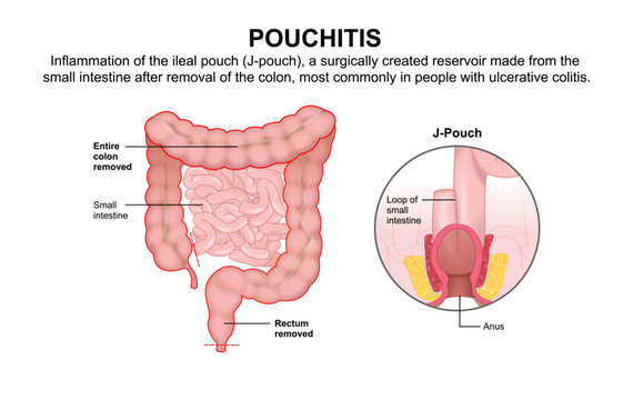 Pouchitis (J-Pouch) Medical Flashcard Illustration
