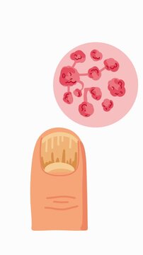 detailed close-up of fungal nail infection