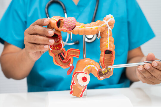 Colorectal cancer, doctor holding intestine colon human anatomy model.