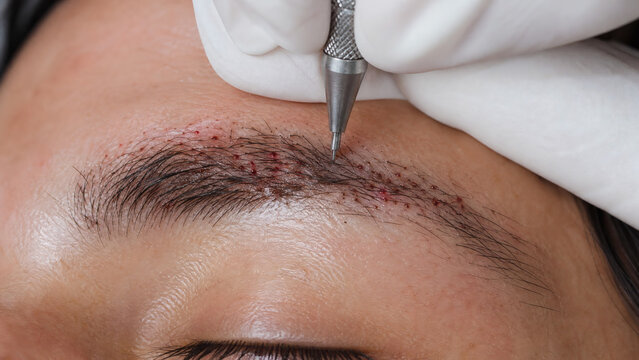 Full frame macro close-up of hair grafts transplantation on female eyebrow, surgeon hands in white gloves inserting follicular units with a precise medical pen tool.