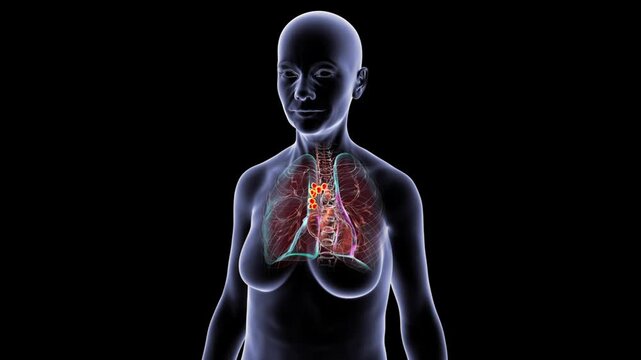 Pulmonary lymphadenitis in female silhouette, 3D animation showing enlarged inflamed lymph nodes within thoracic region, transparent body rotating on black background.