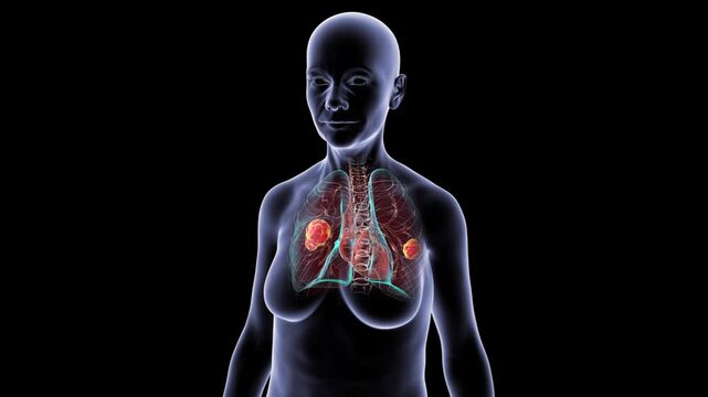 Pulmonary mucormycosis in female silhouette, 3D animation showing invasive fungal lesions within lung tissue, transparent thorax rotating on black background.