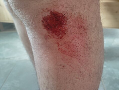 blessure genou sang cro&ucirc;te jambe