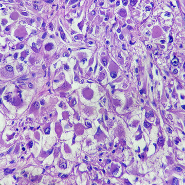 Camera photo of clear cell renal cell carcinoma with rhabdoid features, magnification 400x, photograph through a microscope