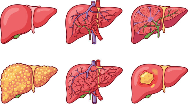 Human liver anatomy and diseases vector collection, hepatic system cirrhosis and tumor illustration set