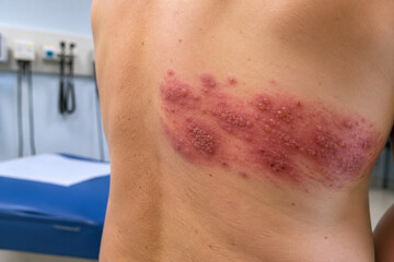 Fototapeta premium Herpes zoster rash on human torso in clinical examination setting