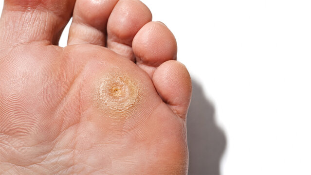 corn on the sole of woman foot. Close up of painful callus or wart on skin. Dermatological problem and foot care. Podiatry treatment concept for skin lesion and foot health issue.