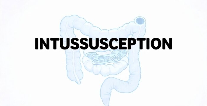 Illustration of human intestinal tract with the word INTUSSUSCEPTION displayed prominently, representing a medical condition of bowel obstruction.