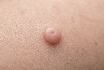 Fototapeta premium Close up of raised pink skin mole or bump on human skin
