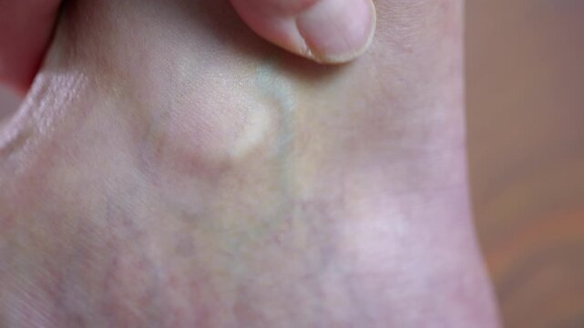 Varicose vein on ankle. Close-up view of a person's finger pressing on a prominent varicose vein on the ankle, highlighting the symptoms of chronic venous insufficiency and vascular disease