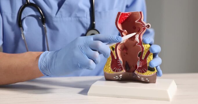 Doctor showing model of unhealthy lower rectum with inflamed vascular structures at light wooden table in clinic, closeup