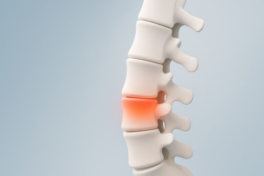 Medical concept of human spine showing lower back pain. glowing red herniated disc between vertebra highlights painful anatomy condition, serious healthcare issue
