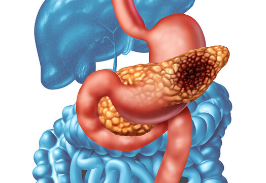 Pancreatic cancer concept as a malignant tumor in the pancreas within the digestive system as an anatomical cross section of abdominal organs including stomach and pancreatic gland presented as a medi