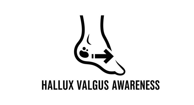 Illustrated Hallux Valgus Awareness Foot Condition Graphic.