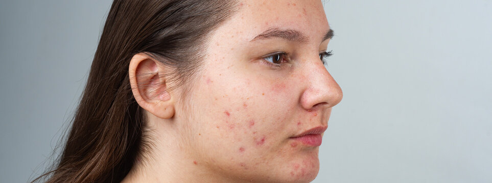 Pimple on cheek in profile. Pimple on skin for dermatology. Pimple on face in closeup. Pimple problem on female skin. Acne closeup on profile face. Acne skin problem on cheek. Acne oily skin.
