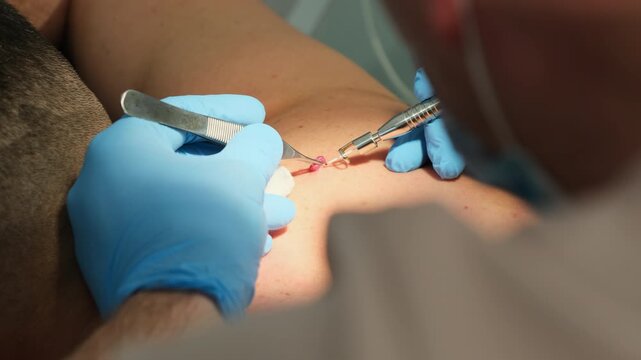 Dermatologist removes suspicious mole with laser coagulation from skin in clinic slow motion. Doctor cuts out melanoma in hospital closeup